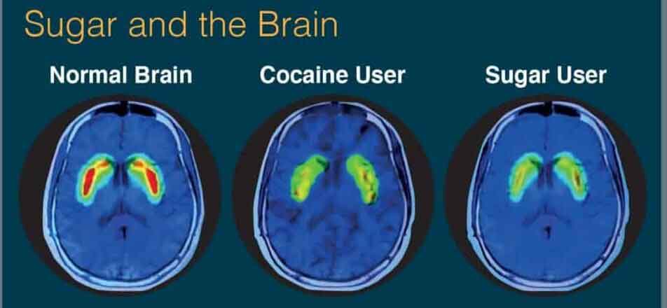 sugar and dopamine