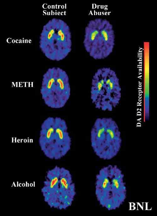 addictive brain